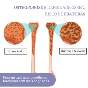 Osteoporose Dra Lizanka Marinheiro Endocrinologista